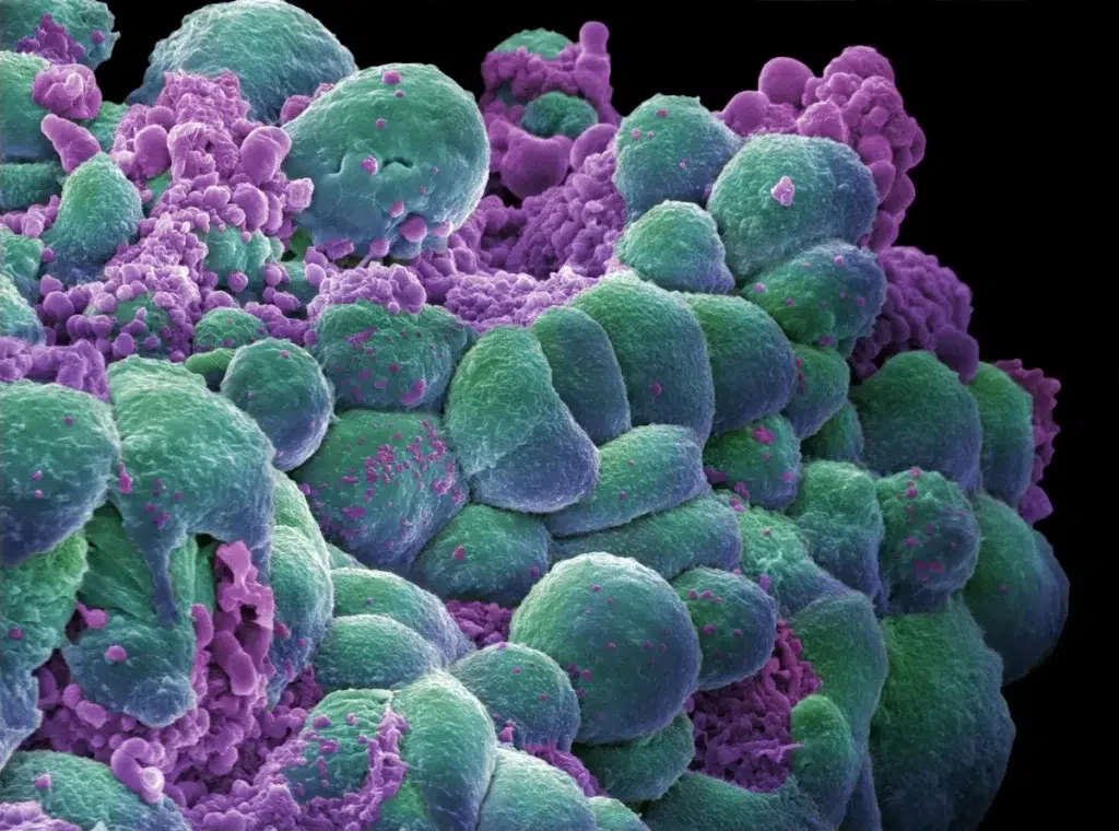 Illustration of pancreatic cancer cells